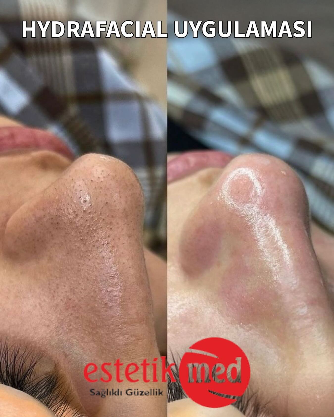 Afyon Estetik Med'de Cilt Bakımıyla Işıltılı Bir Cilde Kavuşun