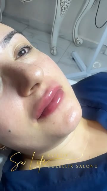 Afyon'da Doğal Dudaklara Kavuşmak Artık Daha Kolay Afyon'da Doğal Dudaklara Kavuşmak Artık Daha Kolay